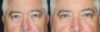 Blepharoplasty case #3315 slider thumbnail