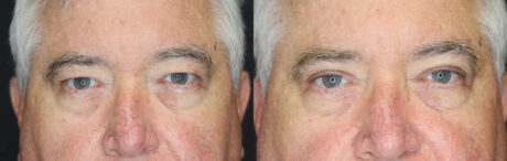 Blepharoplasty case #3315