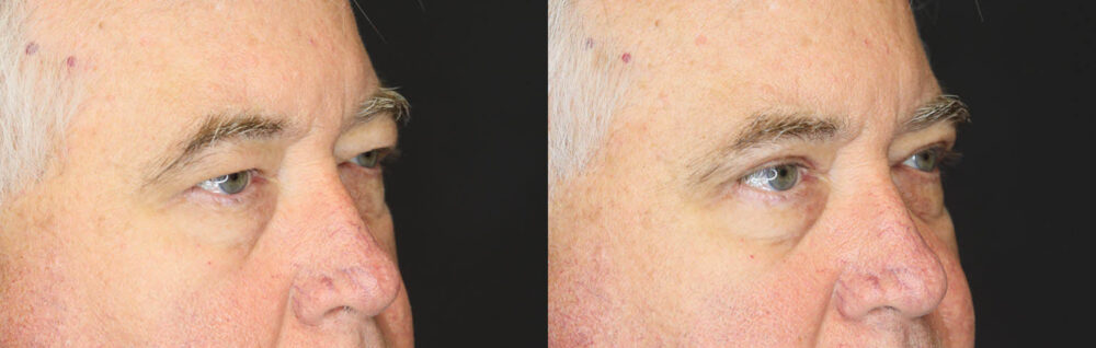 Blepharoplasty case #3315