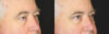Blepharoplasty case #3315 slider thumbnail