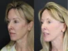 Facelift case #3523 slider thumbnail