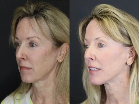 Facelift case #3523