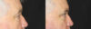 Blepharoplasty case #3315 slider thumbnail