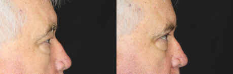Blepharoplasty case #3315