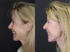 Facelift case #3523 slider thumbnail