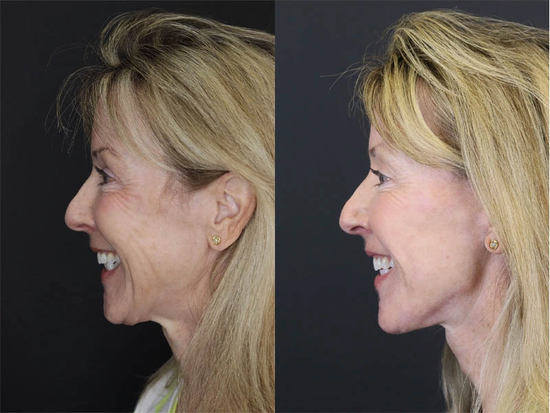 Facelift case #3523
