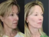 Facelift case #3523 slider thumbnail