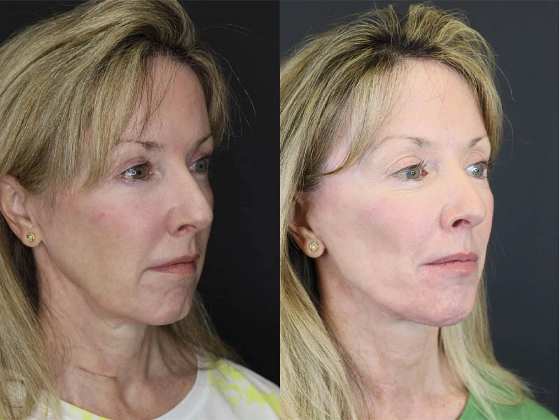 Facelift case #3523