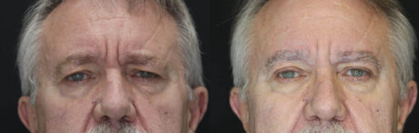 Blepharoplasty case #3343