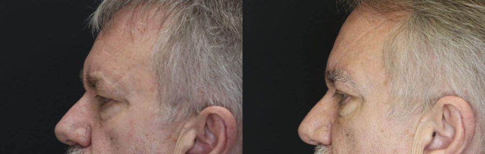 Blepharoplasty case #3343