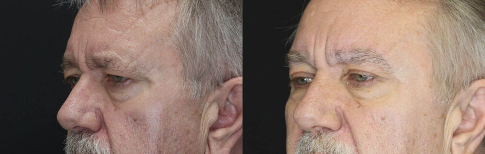 Blepharoplasty case #3343