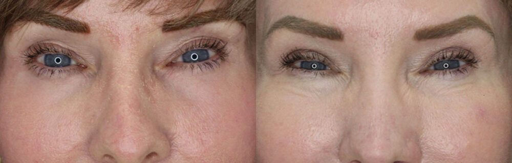Blepharoplasty case #3771