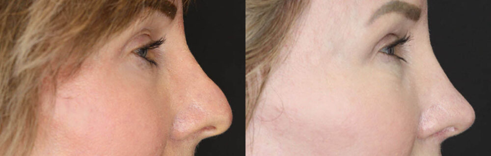 Blepharoplasty case #3771