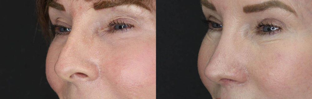 Blepharoplasty case #3771