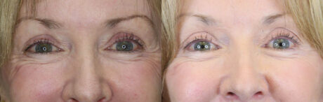 Blepharoplasty case #3800