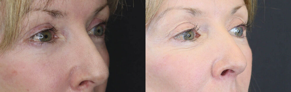 Blepharoplasty case #3800