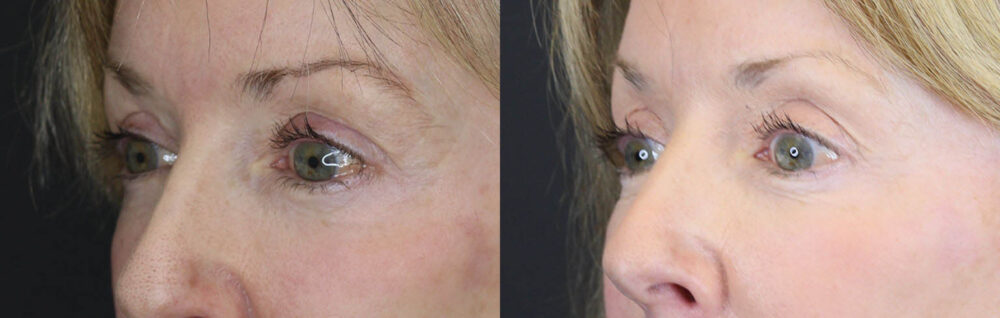Blepharoplasty case #3800