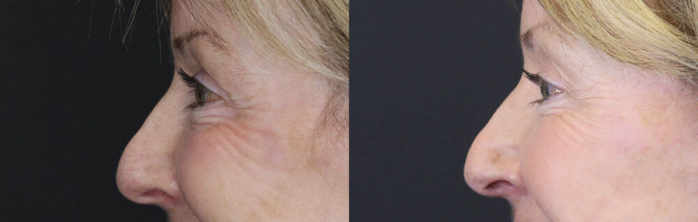 Blepharoplasty case #3800
