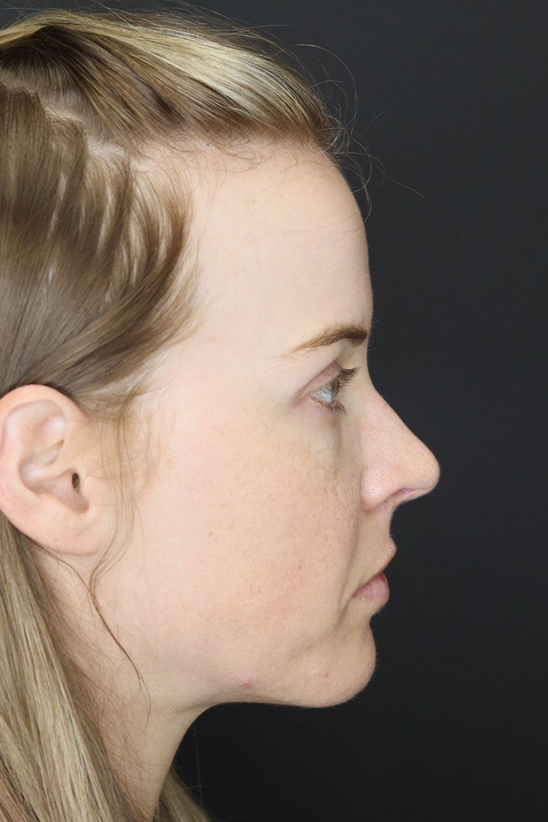 Liquid Rhinoplasty case #3589