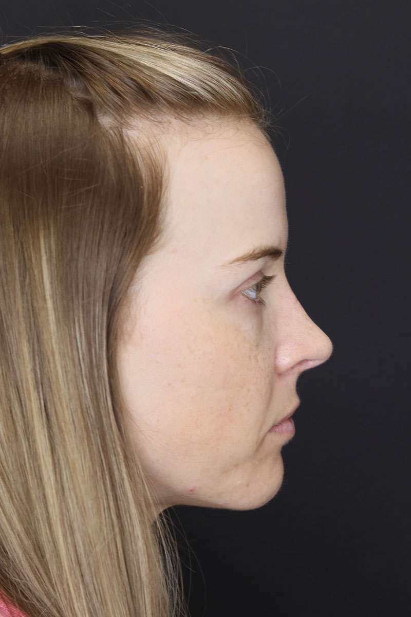 Liquid Rhinoplasty case #3589