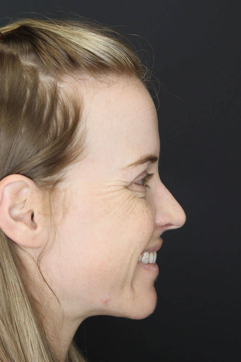 Liquid Rhinoplasty case #3589