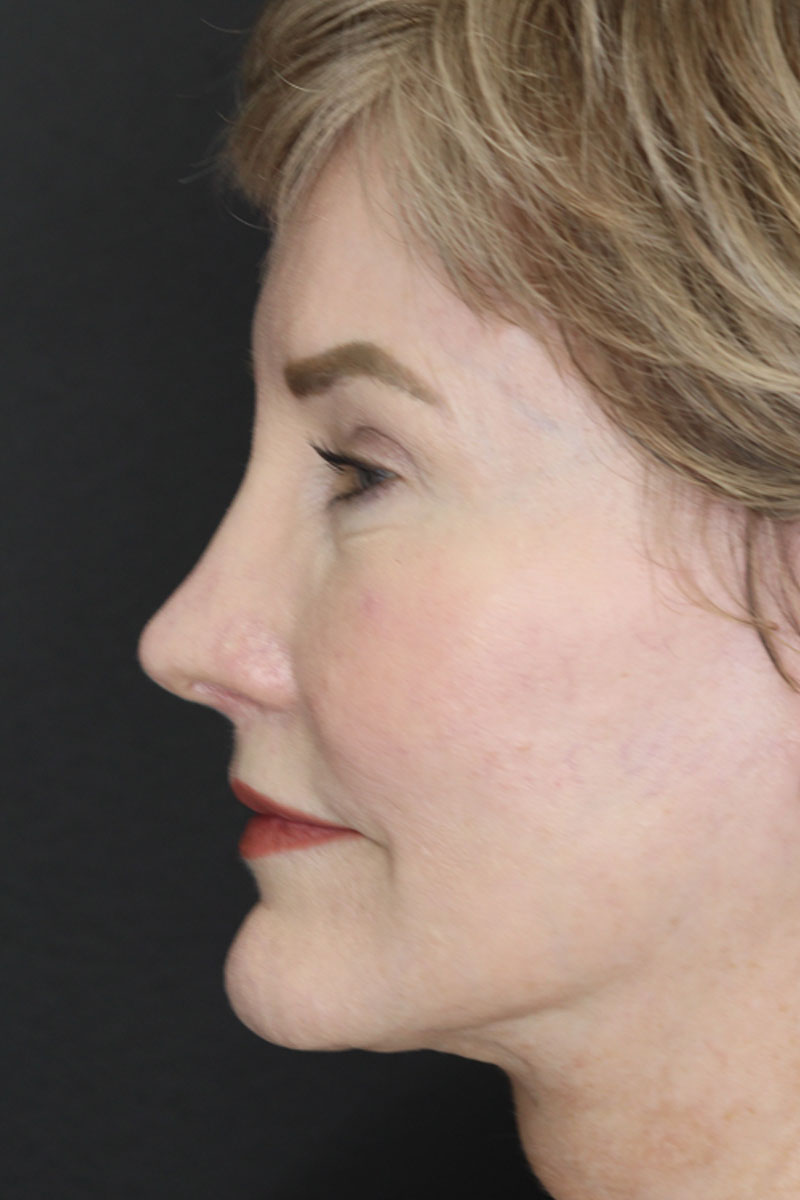 Revision Rhinoplasty case #3596