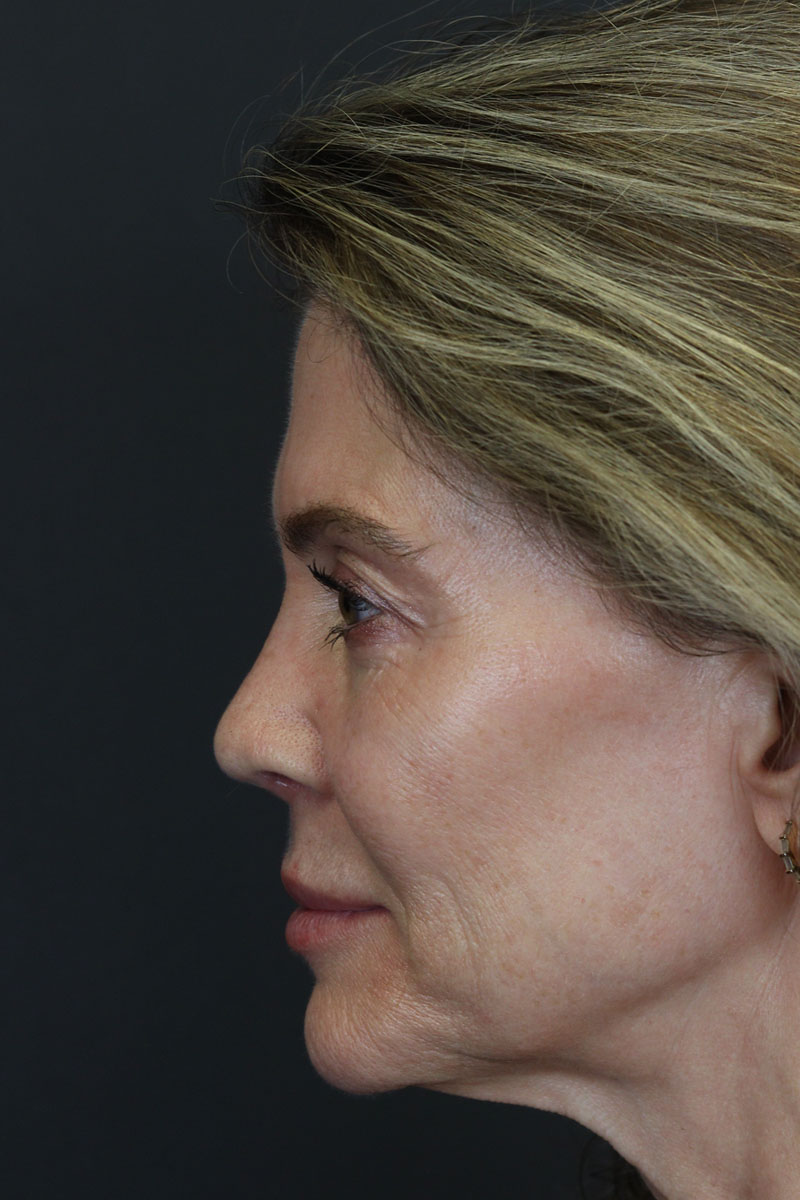 Revision Rhinoplasty case #3753