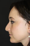 Rhinoplasty case #3461