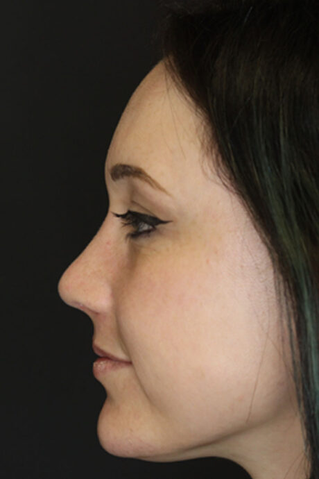 Rhinoplasty case #3461