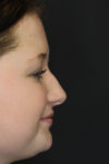 Rhinoplasty case #3482