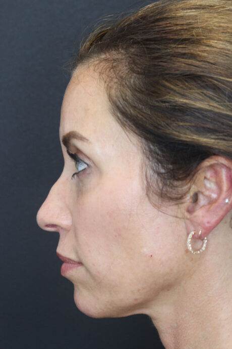 Facial Filler case #3760