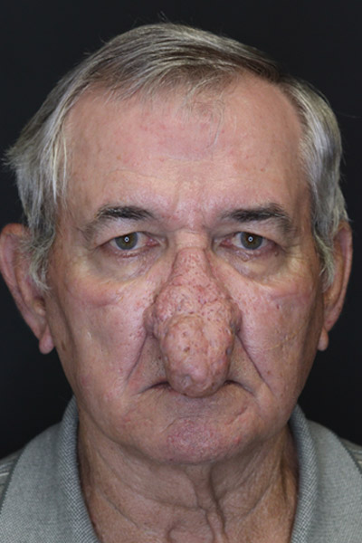 Rhinophyma case #4347