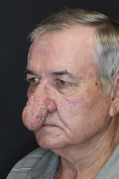 Rhinophyma case #4347