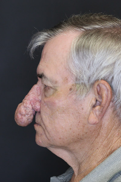 Rhinophyma case #4347