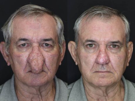 Rhinophyma case #4347