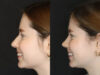 Rhinoplasty case #3946 slider thumbnail