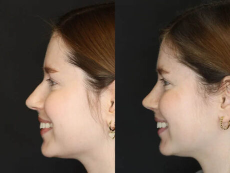 Rhinoplasty case #3946