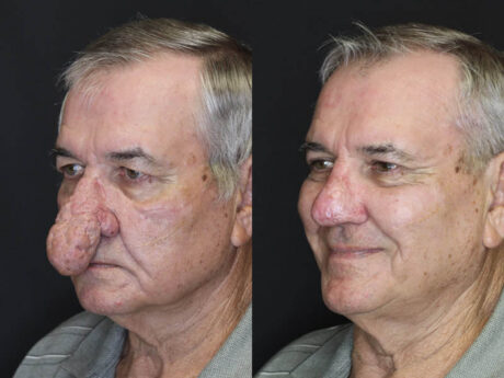 Rhinophyma case #4347