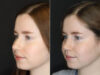 Rhinoplasty case #3946 slider thumbnail