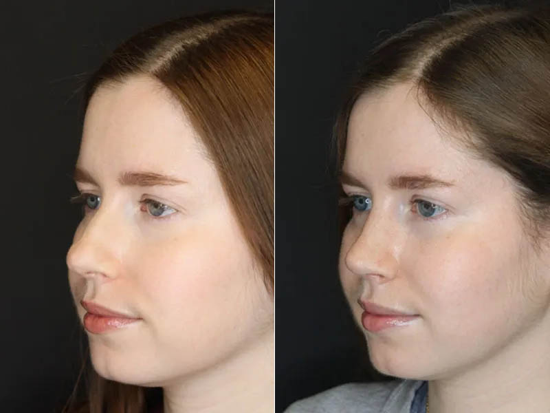 Rhinoplasty case #3946