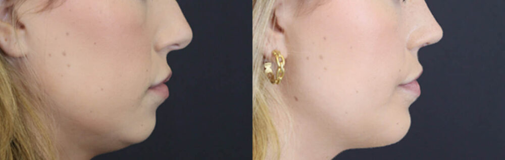 Lip Filler case #4178