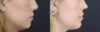 Lip Filler case #4178 slider thumbnail