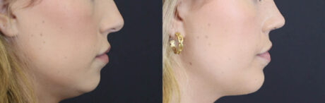 Lip Filler case #4178