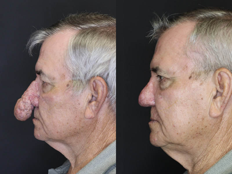Rhinophyma case #4347