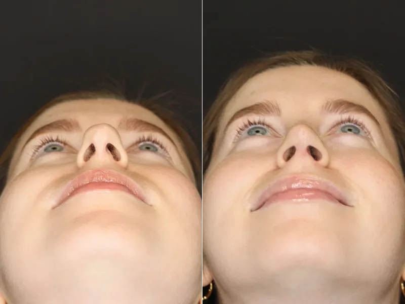 Rhinoplasty case #3946