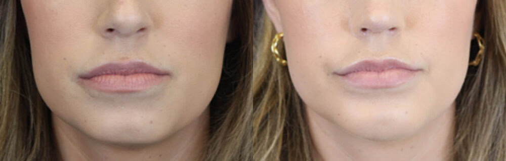Lip Filler case #4178