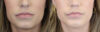 Lip Filler case #4178 slider thumbnail