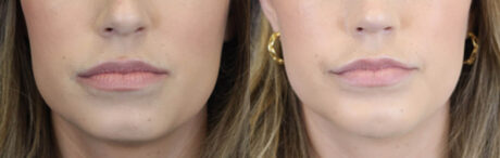 Lip Filler case #4178