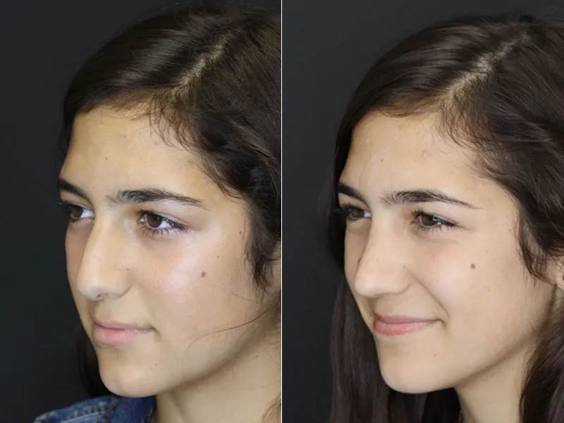 Rhinoplasty case #3967