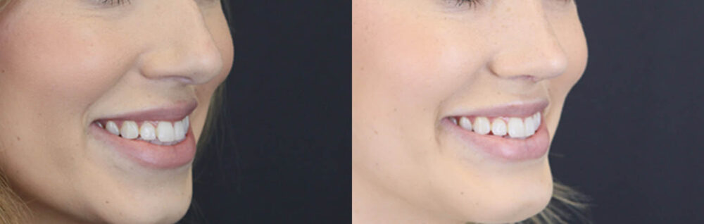 Lip Filler case #4178
